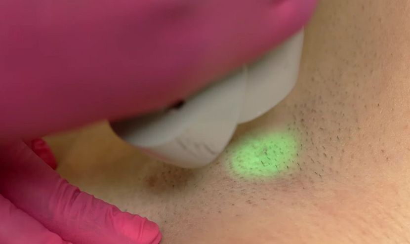 Laserska epilacija Laserska epilacija