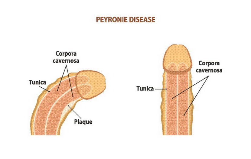 Peyronie's disease, urologija rentgenski snimak Peyronie's disease, urologija rentgenski snimak