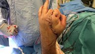 Ovako izgleda ruka koja umalo nije amputirana posle 17 sati spasavanja