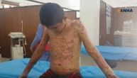 "Tata, zaustavi ovo gorenje kože, preklinjem te": Dečak u nesnosim bolovima posle napada Turske