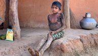 Devojčica se polako pretvara u kamen: Ovu neizlečivu bolest imaju samo 24 osobe na svetu
