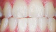 Stomatolog primetio nešto neobično kod pacijenata otkako je počela korona: Šta je to sa zubima?