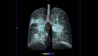 Skener 41-godišnje žene najbolje pokazuje na koji način korona virus uništava naša pluća