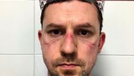 Ožiljci i posekotine na licima Nikole i ostalih medicinskih radnika u Italiji nakon 12 sati borbe