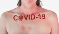 Promena na koži koju nikada ne biste povezali sa korona virusom može biti simptom Covid-19