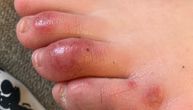 Dermatolozi otkrili novi simptom korona virusa: Kovid prste primetili kod 30 pacijenata