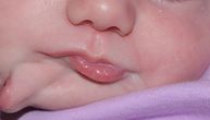 Uznemirujuće fotografije: Beba rođena sa dvoje usta i dva jezika, a onda su počeli da niču i zubi