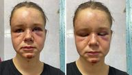 "Još boli dok dišem": Ispovest devojčice koju je slika na Instagramu spasla da je otac ne udavi