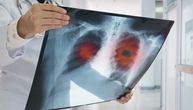 Srbija uvela skrining program za rano otkrivanje raka pluća