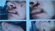 Osamnaestogodišnjaka iz Lebana bivši cimer i maloletnici tukli palicama: Fotografije su zastrašujuće