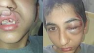 Dečaka (14) iz Srbije policajci pretukli u Parizu: Izbili mu 3 zuba, doktori se bore da mu spasu oko