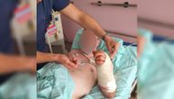 Lekari u Kragujevcu napravili čudo: Pacijentu iz Jagodine za noć spasili otkinutu šaku