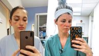 Medicinske sestre pokazale modrice od nošenja maski, pa poručile: Prestanite da se žalite