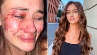 Manekenka Daria brutalno napadnuta u Turskoj: Neću da ćutim, evo šta nam se desilo na plaži