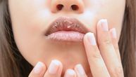 Ispucale usne, opadanje kose, osip na licu: Promene na koži ukazuju na nedostatak ovih vitamina