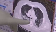 Young non-smoker hospitalized for Covid: Dr. Stevanovic shares CT scan of coronavirus patient