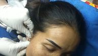 Dermatolog objavio jeziv snimak: Žena "gajila" mitiser 15 godina, iz ušne rese joj izvukli deponiju