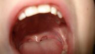 Pogledajte svoj jezik: 6 znakova koji ukazuju na podmukli rak usne duplje