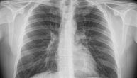 Doktorka iz Pančeva spasla život obolelom od korone i to preko Tvitera: Poslao je ovaj snimak pluća