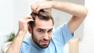 Konačno pronađen lek protiv ćelavosti: Problem gubitka kose kod muškaraca više nije nerešiv
