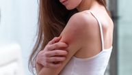Najčudniji novi simptomi kovida-19: Javljuju se na koži i mogu da budu baš neprijatni