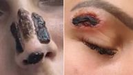 Unakažene žene tokom popularnog tretmana u beogradskom salonu: Imaju uznemirujuće ožiljke