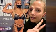 Striptiz bokserka unakažena od batina: Bombastična Australijanka dobila zastrašujuću "šljivu" na oku