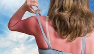 Koliko su opasne opekotine od sunca i kako ih tretirati: Jedna grupa ljudi je posebno ugrožena