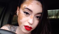 Vređali su je, zagledali i diskriminisali: Devojka sa vitiligom postala model i inspiracija mnogima