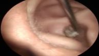 Vađenje gljive iz ušnog kanala: Prvo je izgubio sluh, onda je zabolelo, pa počelo da smrdi