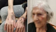 Zaštitnik građana pokrenuo postupak povodom slučaja bake iz staračkog doma: Puštena s modricama na rukama