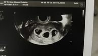 Doktorka je objavila sliku sa ultrazvuka i rasplakala Srbiju: 2 godine je trajala borba. Srećno, J, trojke!