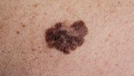 Prvi znakovi raka kože: Evo kakve vrste promena treba da vas zabrinu i na kom delu tela
