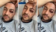 Crnogorski influenser se oglasio nakon operacije: Snimao se u jezivom stanju, lekari ga upozorili