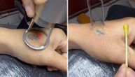 Da li ste nekada videli kako izgleda uklanjanje tetovaža?