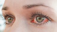 Stručnjak otkriva 5 zdravstvenih problema na koje može da ukaže crvenilo u očima