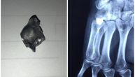 Ovo je metak koji je izvađen iz šake srpskog mladića: Objavljen i rentgenski snimak