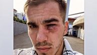 Jeziva povreda srpskog fudbalera: Ovako izgleda oko veziste nakon što mu je protivnik kopačkom stao na lice