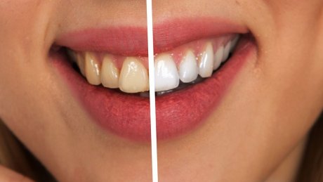 zubi razlika izbeljivanje zuba