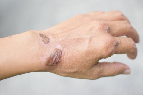 ruka ruke rana rane sepsa opekotine ruka ruke rana rane sepsa opekotine