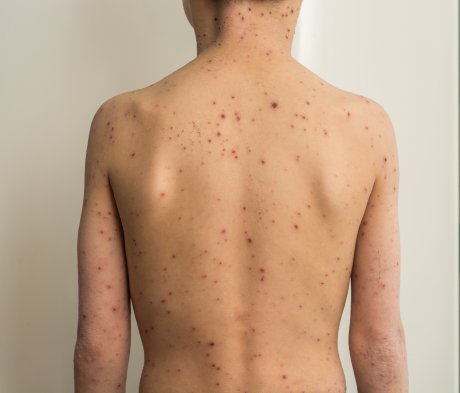 boginje, koza, promene, osip, dermatologija, tinejdžer, mladić, muškarac, dečak, zaraza boginje, koza, promene, osip, dermatologija, tinejdžer, mladić, muškarac, dečak, zaraza