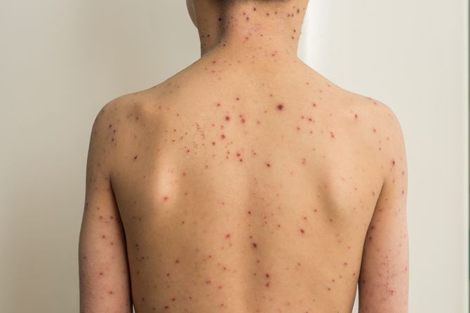 boginje, koza, promene, osip, dermatologija, tinejdžer, mladić, muškarac, dečak, zaraza boginje, koza, promene, osip, dermatologija, tinejdžer, mladić, muškarac, dečak, zaraza