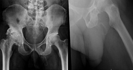 Peyronie's disease, urologija rentgenski snimak