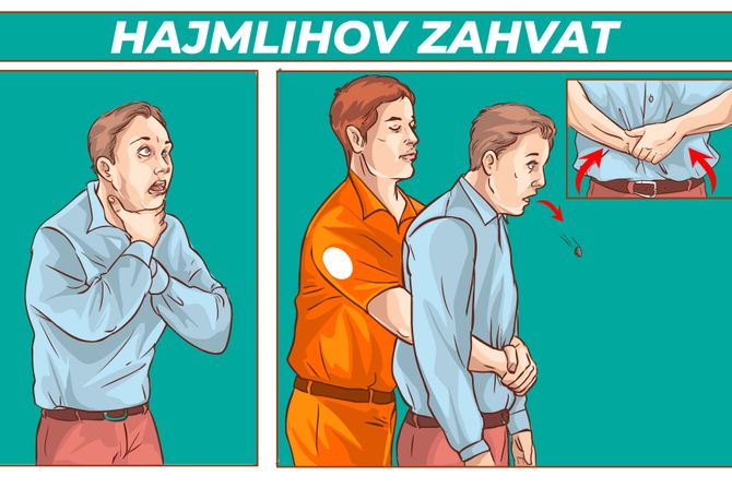 Heimlich maneuver, Hajmlihov zahvat