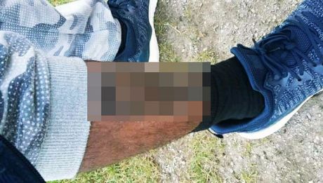 Migrant sa spaljenom nogom