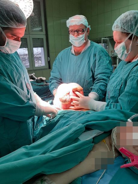 Tumor od pola metra, beogradski lekari, operacija Tumor od pola metra, beogradski lekari, operacija