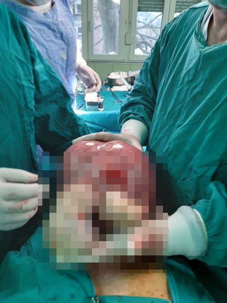 Tumor od pola metra, beogradski lekari, operacija Tumor od pola metra, beogradski lekari, operacija