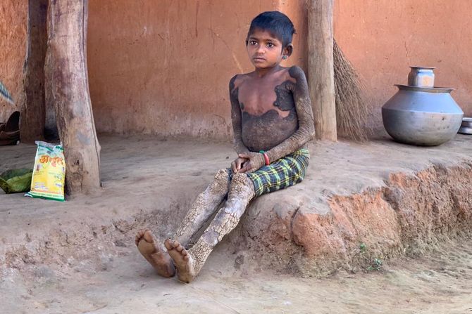 Devojčica se pretvara u kamen Devojčica se pretvara u kamen