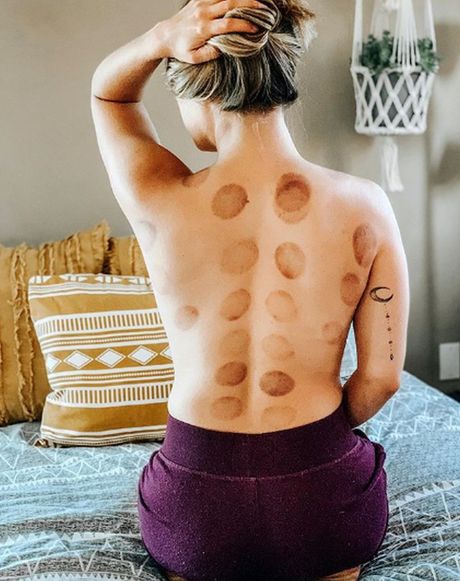 Masaža čašama Masaža čašama