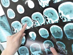 CT scan, snimak rengenski glave, mozak, bolest, dijagnoza, dijagnostika, Multiple sclerosis, Multipla skleroza,